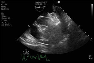 Plano medioesofágico 4 cámaras con dispositivo anclado en la válvula mitral.