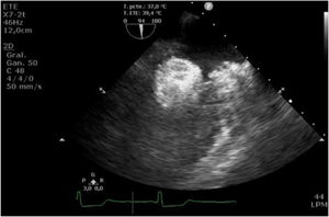 Plano medioesofágico dos cámaras.