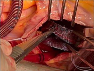 Extracción quirúrgica del dispositivo.