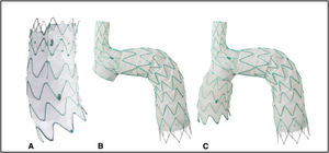 Sistema de endoprótesis Nexus™. A)Módulo proximal para aorta ascendente. B)Módulo principal con rama para tronco braquiocefálico. C)Aspecto final de la prótesis con ambos módulos ensamblados.