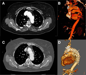 A,B)Corte de TC y reconstrucción preoperatoria. C,D)Corte de TC y reconstrucción postoperatoria.