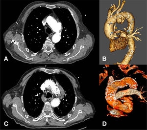 A,B)Corte de TC y reconstrucción preoperatoria. C,D)Corte de TC y reconstrucción postoperatoria.