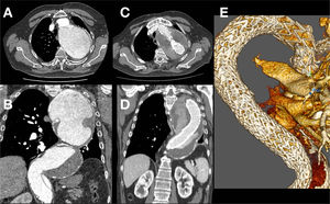 A,B)Corte de TC preoperatorio objetivando disección tipoB sobre aorta torácica aneurismática. C,D)Corte de TC postoperatorio. E)Reconstrucción postoperatoria, desde una visión posterior derecha, con correcta exclusión de luz falsa.