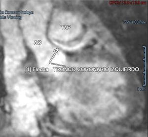 Angiotomografía donde se observa que el tronco coronario izquierdo nace de la arteria pulmonar. AO: aorta; TAP: tronco de la arteria pulmonar.