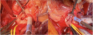 Realización de túnel aortopulmonar para comunicar el ostium coronario izquierdo hacia la comunicación aortopulmonar.