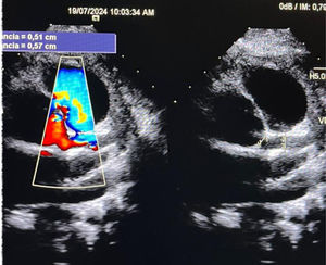 Ecocardiograma posquirúrgico. No hay fuga en el túnel aortopulmonar.