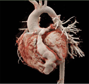 Angiotomografía que muestra gran fístula coronaria del segmento distal de la arteria descendente anterior que desemboca a la región apical del ventrículo derecho.