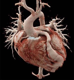Angiotomografía con dilatación ectásica de los segmentos proximal y medio de la coronaria derecha, además de la raíz aórtica y aorta ascendente.
