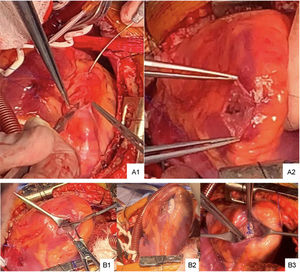 A1: introducción del dilatador en la descendente anterior. A2: ventriculotomía. B1: desembocadura de la fístula coronaria al ventrículo derecho con paso del dilatador. B2: colocación de parche en la fístula de la descendente anterior al ventrículo derecho. B3: Parche doble velour con puntos.