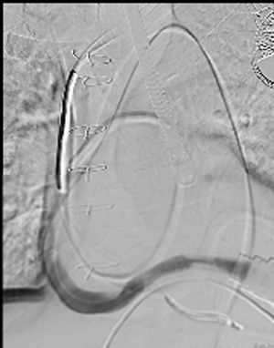 Imagen angiográfica previa al procedimiento, donde se identifica una estenosis severa del outflow con paso restringido del contraste.