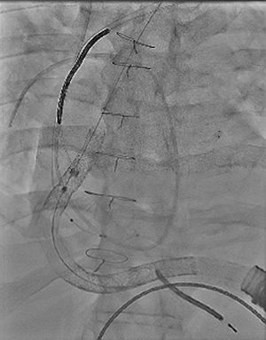 Resultado final tras angioplastia percutánea con implantación de stents, mostrando adecuada permeabilidad del conducto de salida y mejora del flujo.