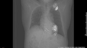 Imagen radiológica que muestra la incorrecta posición del dispositivo HM3™, con orientación hacia el septo interventricular medio. Se observa colapso del ventrículo izquierdo y signos sugestivos de fenómenos de succión, que motivaron la reintervención quirúrgica.