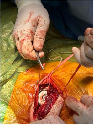 Detalle intraoperatorio del protocolo de reposicionamiento del HM3™ mediante sistema de anclaje con cintas de cérvix. Estas se fijan a nivel de la quinta costilla en el espacio intercostal posterior, proporcionando estabilidad y adecuada orientación del dispositivo.