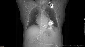 Radiografía de control tras la reintervención quirúrgica, donde se aprecia la rotación del HM3™ con correcta alineación del inflow hacia el ápex del ventrículo izquierdo, confirmando el éxito del reposicionamiento.
