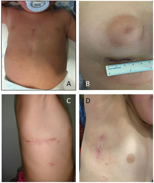 Imágenes de miniesternotomía inferior (A), minitoracotomía submamaria (B), incisión axilar horizontal (C) y vertical (D).