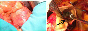 Complicaciones de la EI sobre TAVI. A) Protrusión del strut del stent en la pared aórtica. B) Presencia de absceso anular tras el explante de la TAVI.
