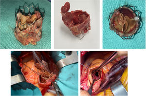 Prótesis aórticas transcatéter con presencia de vegetaciones en sus velos que cubren parcialmente el stent en el contexto de endocarditis infecciosa.