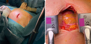 Minitoracotomía anterior izquierda. Incisión cutánea (a). Exposición de ADA (b).