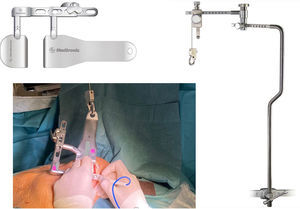 Sistema de retracción costal ThoraTrack® y sistema para exposición de la AMI RulTrack®.