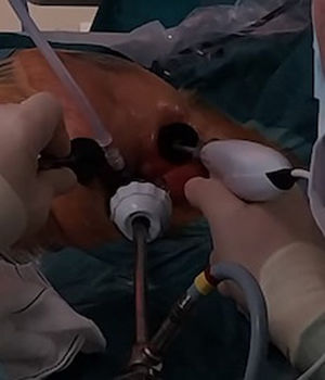 Disección endoscópica de AMI.