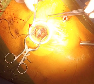 Anastomosis AMI-ADA tras disección de AMI con robot24.