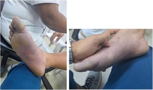 Cianosis distal en pie derecho.