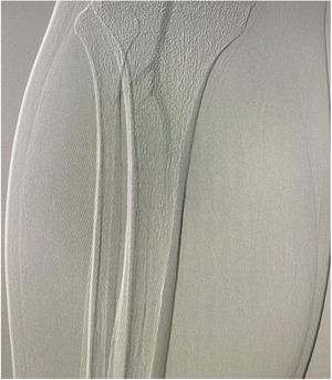 Arteriografía de miembro inferior derecho con oclusión de tibial anterior y tronco tibioperoneo.