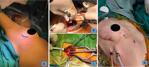 Surgical technique. (A) Patient position. (B) Access through the 4th intercostal space. (C) Arterial and venous femoral cannulation. (D) Final result.