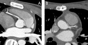 TAC pre- y postoperatorio de coronaria izquierda con origen anómalo en el seno derecho: A) Nótese la proximidad del primer trayecto «normal» de la coronaria al anillo aórtico. B) Neo-ostium en el nadir del seno correspondiente.