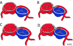 Corrección anatómica: A) CI con origen anómalo en seno derecho. B) Apertura de pared aórtica y coronaria izquierda. C) Sutura lado-a-lado de aorta y coronaria (en trayecto «normal»). D) Ampliación con parche de pericardio.