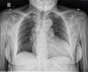 AP projection, chest without bone lesions. Cardiothoracic index 0.6. Prominent aortic knob.
