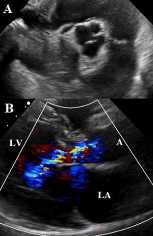 (A) Subcostal view in great vessels showing quadricuspid aortic valve, sclerosis of its cusps, adequate opening, deficient closure. (B) Color Doppler, regurgitant jet, VC: 7mm (A: aorta; LV: left ventricle; LA: left atrium).