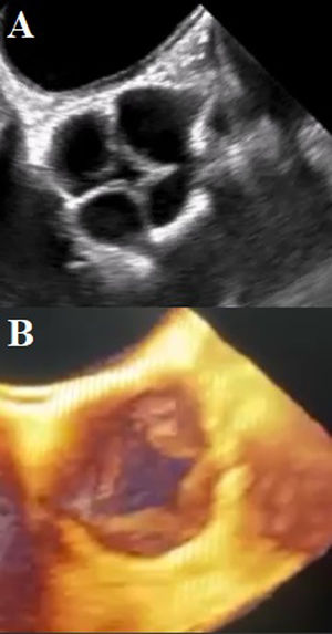 (A) TEE mid-esophageal view in great vessels at 100 degrees. Showing quadricuspid aortic valve with thickened cusps. Commissural coaptation in an “X” shape in diastole. (B) 3D reconstruction of the quadricuspid aortic valve with a supernumerary cusp between the left and right coronary cusps.