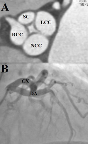 (A) Contrast tomography. Quadricuspid aortic valve. The supernumerary cusp (SC) is observed between the left and right coronary cusps (Nakamura type I). (LCC: left coronary cusps; RCC: right coronary cusps; NCC: non-coronary cusps). (B) Right anterior oblique projection with skull angulation, showing independent origin of the left anterior descending and circumflex arteries (DA: anterior descending artery; CA: circumflex artery).