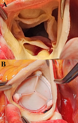 (A) Native quadricuspid aortic valve. (B) Biological valve prosthesis.