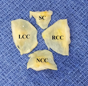 QAV Hurwitz and Roberts type F (two equal larger cusps and two unequal smaller cusps) and Nakamura type I. Histopathological study reported edema, fibrosis, hyalinization, and foci of calcification.