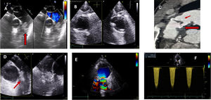 Imágenes de endocarditis pulmonar. A)Imagen de ETE de endocarditis pulmonar nativa en paciente en UCI. Vegetación de gran tamaño en planos valvular pulmonar en plano medioesofágico alto de grandes vasos. B,C)Endocarditis protésica pulmonar. Imagen de ETT sin vegetaciones (B). TAC con engrosamiento de velos protésicos y absceso perianular (flechas). D-F)Imágenes de paciente con vegetaciones y trombo en prótesis pulmonar biológica percutánea (Melody) (ETE flechas [D]). Turbulencia en flujo transvalvular pulmonar y gradientes elevados (E,F).
