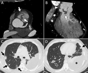 Varón de 47 años, ex-ADVP, que ingresa por fiebre y bacteriemia por Staphylococcus aureus. Las imágenes en planos axial (A) y coronal oblicuo (B) confirman la presencia de vegetaciones de gran tamaño sobre la válvula pulmonar nativa (flechas blancas), así como aumento de partes blandas perivalvular sugestivo de flemón/absceso e irregularidad con saculación de la raíz de la pulmonar compatible con pseudoaneurisma (B, cabezas de flecha). Se identificaron múltiples lesiones nodulares pulmonares bilaterales (flechas negras), alguna de ellas cavitada (D, flecha vacía), compatibles con embolias pulmonares, asociadas a derrame pleural izquierdo (D, asterisco).