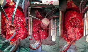Imágenes intraoperatorias de EI sobre prótesis Melody® implantada en homoinjerto pulmonar. Procedimiento de Ross previo.