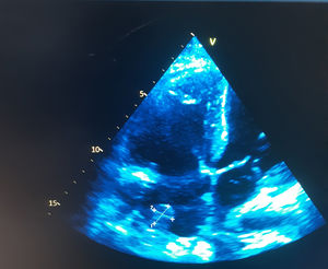 Ecocardiograma transtorácico de control luego de 3 semanas de terapia antibiótica, mismas dimensiones con respecto al anterior.