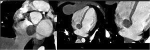 Tomografía cardiaca en la cual se observa lesión quística en aurícula derecha por arriba del ostium del seno coronario.