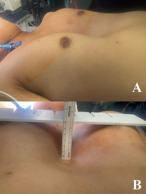 Pectus excavatum.