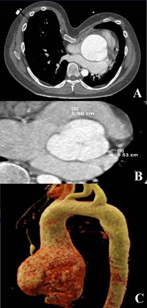 (A) Axial slice for assessment of the Haller index. Note the leftward displacement of mediastinal structures. (B) Measurement at the level of the sinuses of Valsalva. (C) 3D reconstruction of the aorta demonstrating an ascending aortic aneurysm.