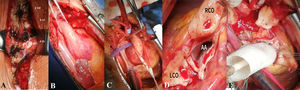 (A) Following skin and subcutaneous tissue incision, the sternum is exposed along with deformed costal cartilages. (B) Ascending aortic aneurysm. The transverse sinus of Theile is dissected and isolated with a tape. (C) Central cannulation and aortic cross-clamping. (D) AA: aortic annulus; coronary buttons are prepared. RCO: right coronary ostium. LCO: left coronary ostium. (E) A prefabricated Dacron graft with a mechanical aortic valve is implanted.