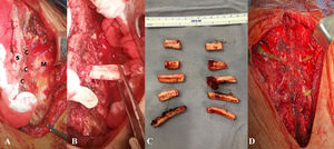 (A) Preparation of muscular flaps is initiated, and costal cartilages from the 2nd to the 6th ribs are dissected (S: sternum; C: cartilage; M: muscle). (B) Resection of costal cartilages is performed, preserving the periosteum and avoiding injury to the neurovascular bundle. (C) Resected costal cartilages. (D) Titanium bars from the STRATOS system are placed.