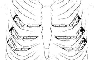 Representative schematic of Stratos system placement.