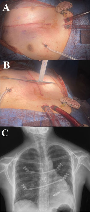 (A and B) Postoperative view of corrected pectus excavatum. (C) Postoperative follow-up chest X-ray.