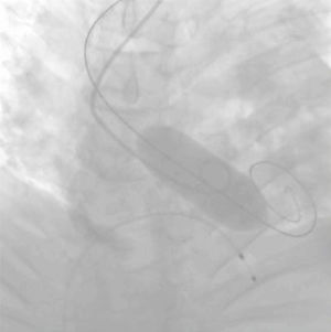 Pre-dilatación con balón durante implante de TAVI.