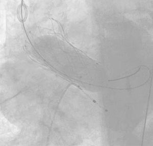 TAVI autoexpandible implantada y sometida a post-dilatación.