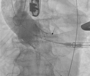 Imagen de regurgitación periprotésica tras implante de TAVI balón-expandible.